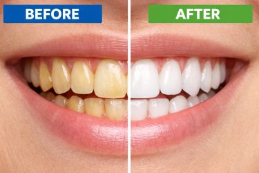 Before and after teeth whitening showing yellow stained teeth compared to bright white results after professional treatment