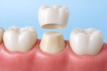 Illustration of a dental crown lifted off a prepared natural tooth.